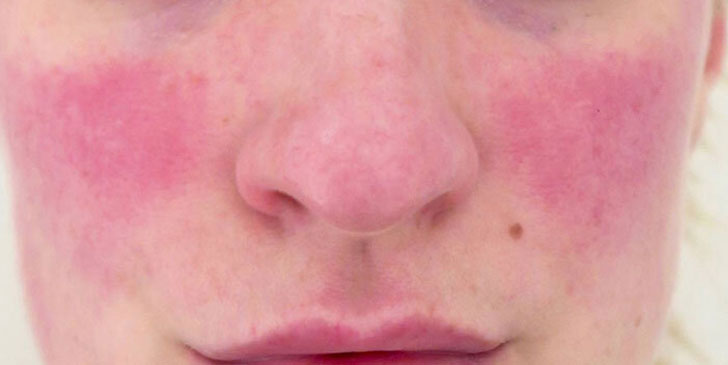 rosacea